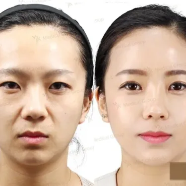 Facelifting