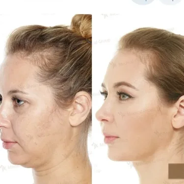 Facelifting