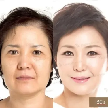 Facelifting