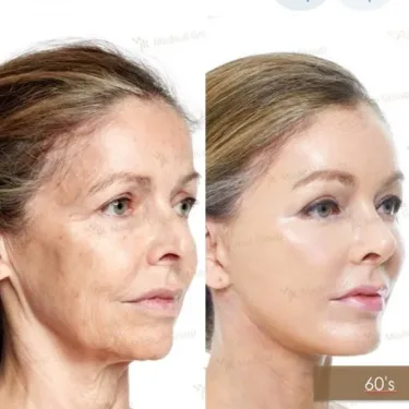 Facelifting