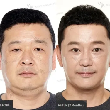 Facelifting