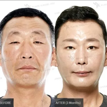 Facelifting