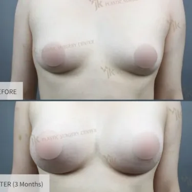 Mammoplasty - Breast Augmentation