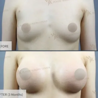 Mammoplasty - Breast Augmentation