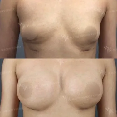 Mammoplasty - Breast Augmentation