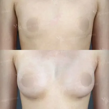Mammoplasty - Breast Augmentation