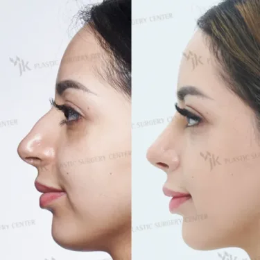 Rhinoplasty