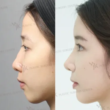 Rhinoplasty