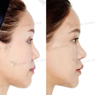 Rhinoplasty