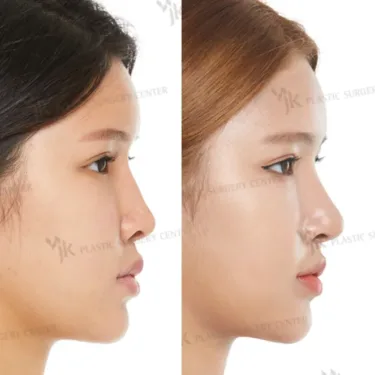 Rhinoplasty