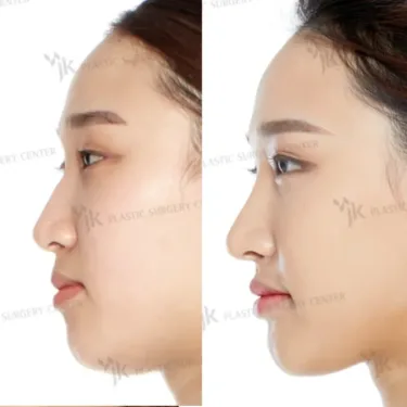Rhinoplasty