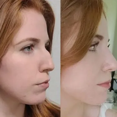 Rhinoplastik