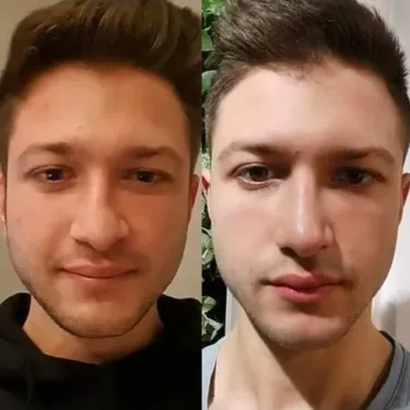 Rhinoplastik