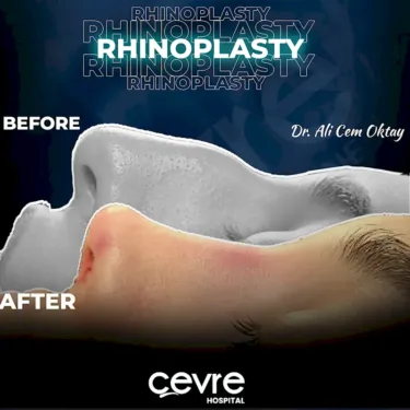 Rhinoplastik