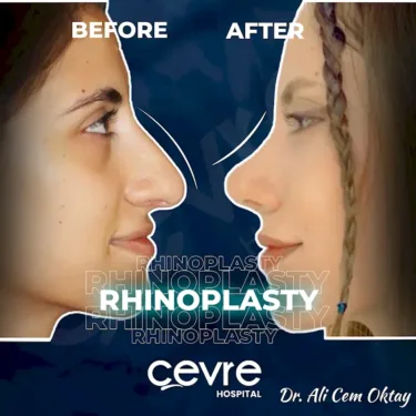 Rhinoplastik