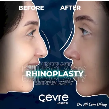 Rhinoplastik