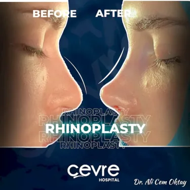 Rhinoplastik