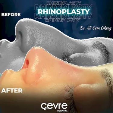 Rhinoplastik
