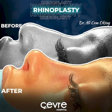 Rhinoplastik