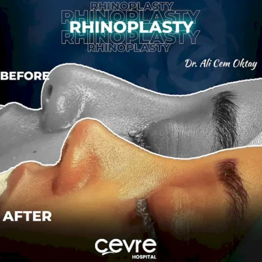 Rhinoplastik