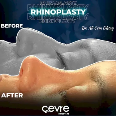 Rhinoplastik