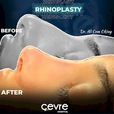 Rhinoplastik