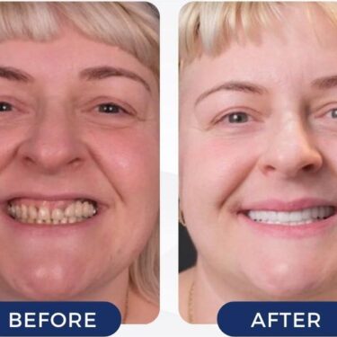 Hollywood Smile