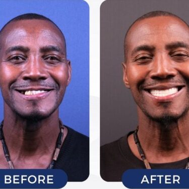 Hollywood Smile