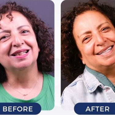 Hollywood Smile