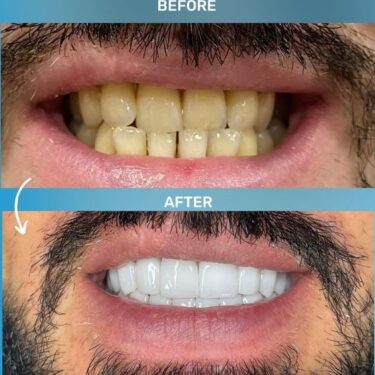 Hollywood Smile