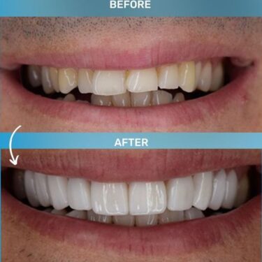 Hollywood Smile