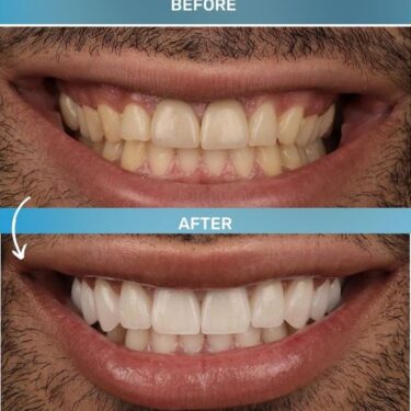 Hollywood Smile