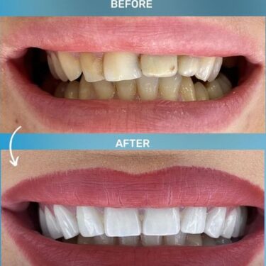 Hollywood Smile
