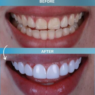 Hollywood Smile