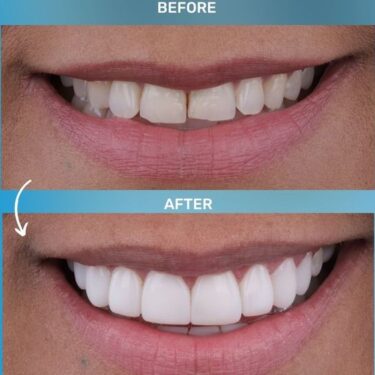 Hollywood Smile