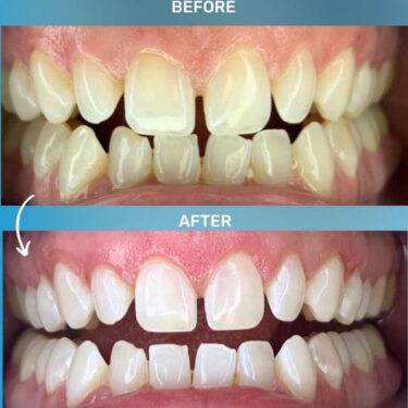 Teeth Whitening