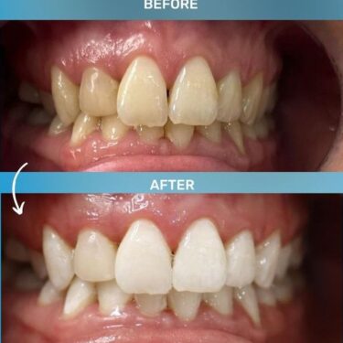 Teeth Whitening
