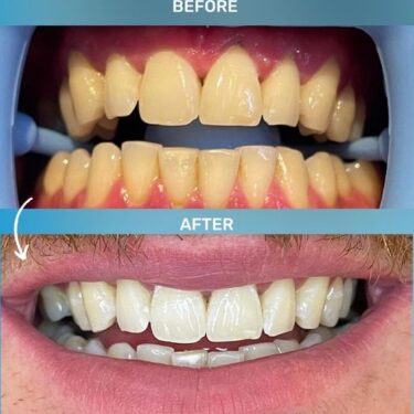 ОтTeeth Whitening