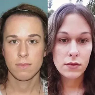 Feminization of the face