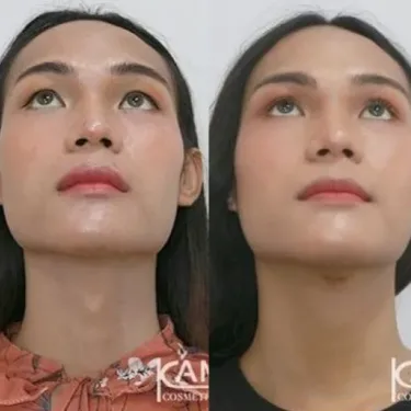 Удаление Адамового яблока