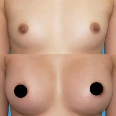 Breast augmentation with implants