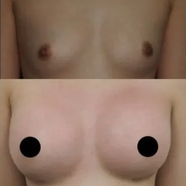 Breast augmentation with implants