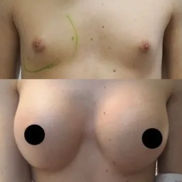 Breast augmentation with implants
