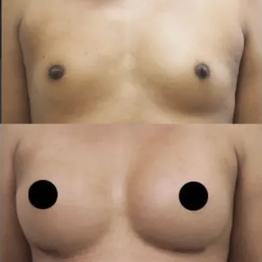 Breast augmentation with implants