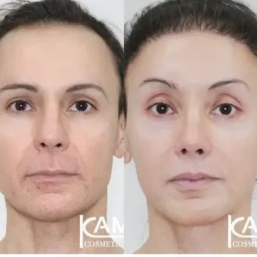 Feminization of the face