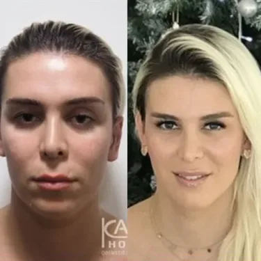 Feminization of the face