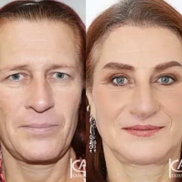 Feminization of the face