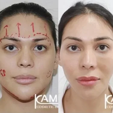 Feminization of the face