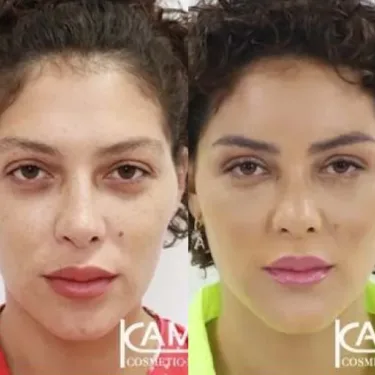 Feminization of the face