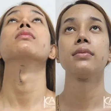 Удаление Адамового яблока